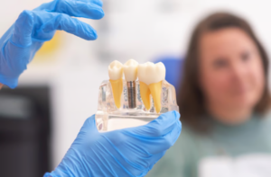 Understanding the Dental Implant Process Step by Step
