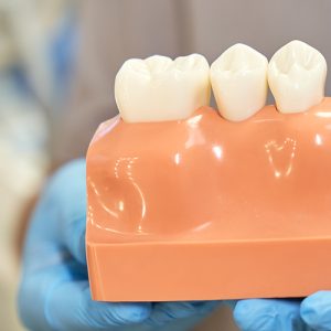 Dental-Crowns