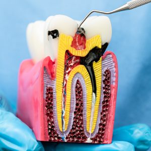 Root-canal-treatment